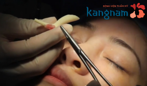 nang-mui-co-dat-khong 3