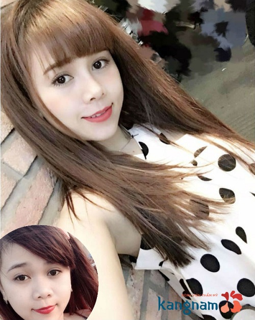 Giải đáp: Nâng mũi S line có đau không?