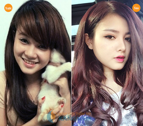 Phẫu thuật nâng sửa mũi Hàn Quốc có đau không?