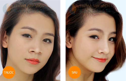 Trước và sau khi sửa mũi tại kangnam