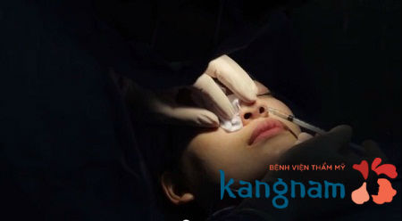Thu gọn cánh mũi có đau không và có ảnh hưởng gì không?