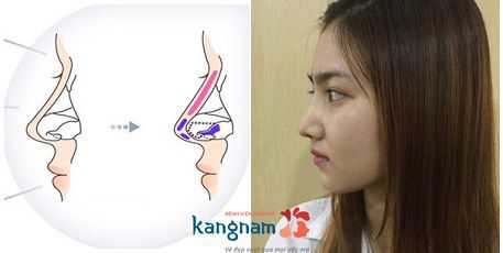 Sửa mũi S line là gì? Ưu điểm nổi bật của sửa mũi Sline 3D là gì?