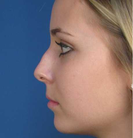 Nâng mũi S line Hàn Quốc – Giải pháp khắc phục mũi gãy hiệu quả