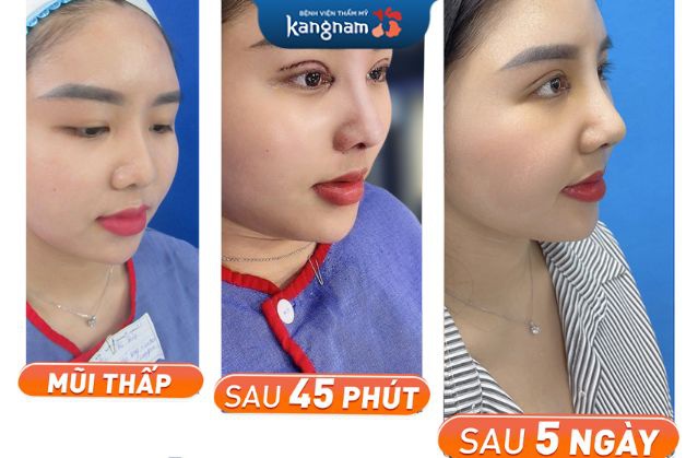 Nâng mũi 6D không đau tại Kangnam