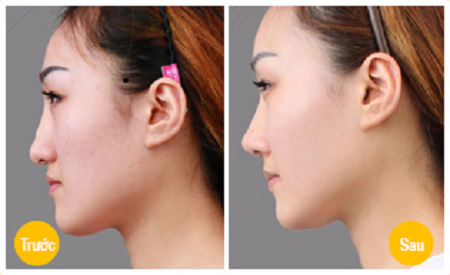 Phẫu thuật nâng mũi, sửa mũi giá bao nhiêu tiền? Giá sốc 2017