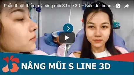 Sửa mũi S line là gi 3