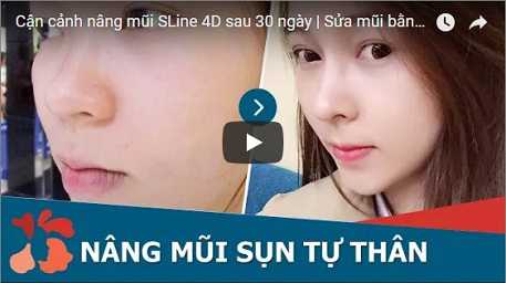 Sửa mũi S line là gi 4